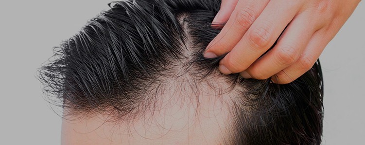 alopecia-androgenetica-calvicie