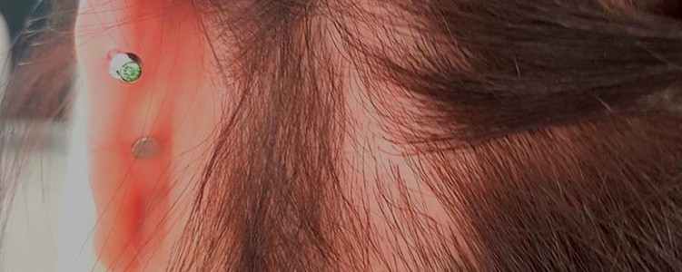 alopecia-de-tração